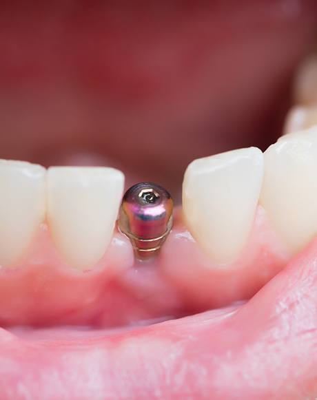 closeup of dental implant in patient’s mouth 