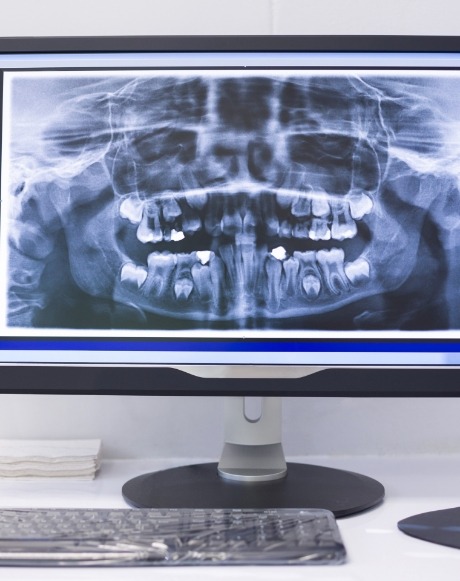 Digital x-rays on chairside computer monitor
