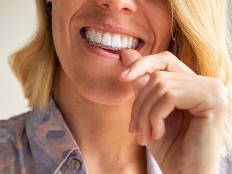 woman putting Invisalign aligners over her teeth
