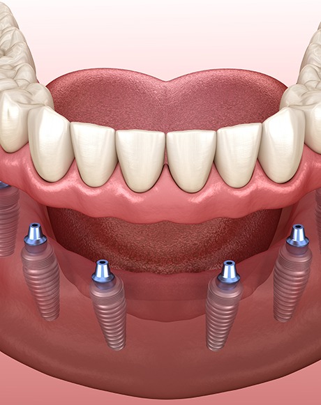 Digital illustration of implant dentures