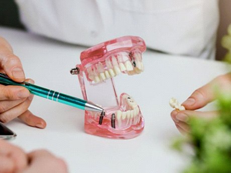 a dentist explaining how dental implants work with a model