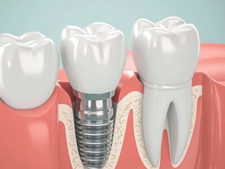 a 3D illustration of a dental implant in the jawbone