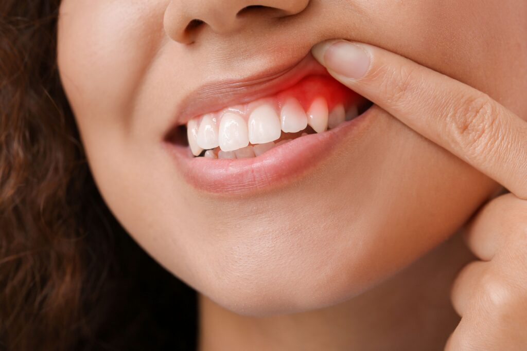 Nose-to-chin view of woman pulling back upper lip to reveal red gums